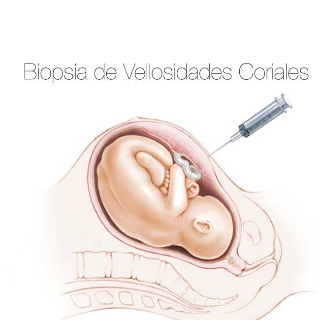 biopsia corial